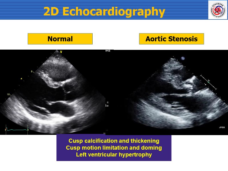 2D Echocardiography Normal Aortic Stenosis Cusp calcification and thickening Cusp motion limitation and doming